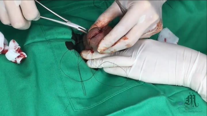 时效已过 超狠 女主 医疗 血腥 割尿道 缝合